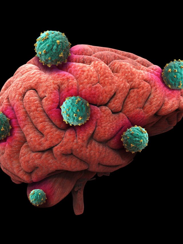 HOW TO SHRINK BRAIN TUMORS