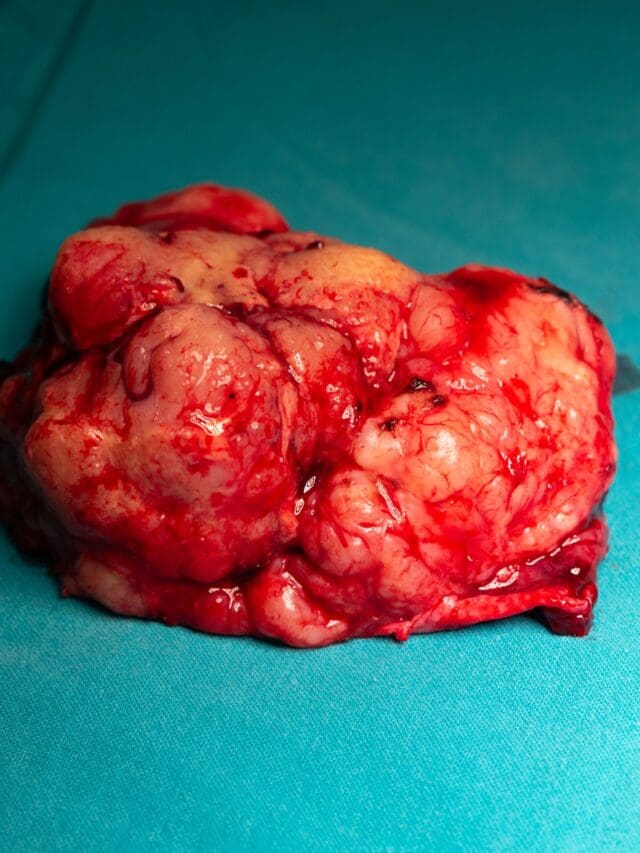 MENINGIOMA: IS A 7MM SMALL?