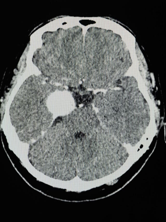 CAN A BRAIN TUMOR BE SHRUNK WITHOUT SURGERY?